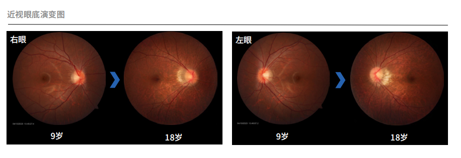 AI_慢性病早筛_鹰瞳Airdoc_爱康集团-7